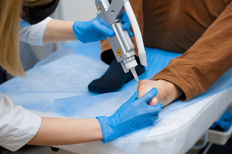 Verruca Removal